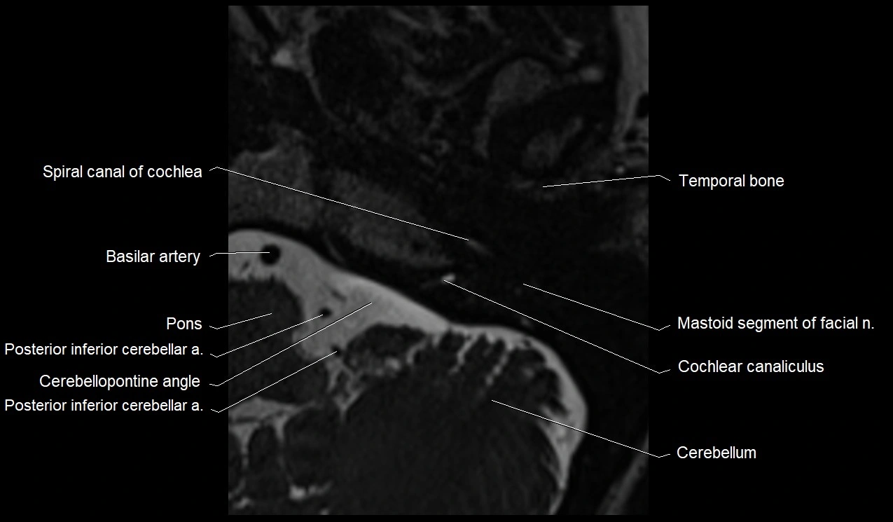 Internal auditory canal (IAC) axial cross sectional anatomy image 2.webp